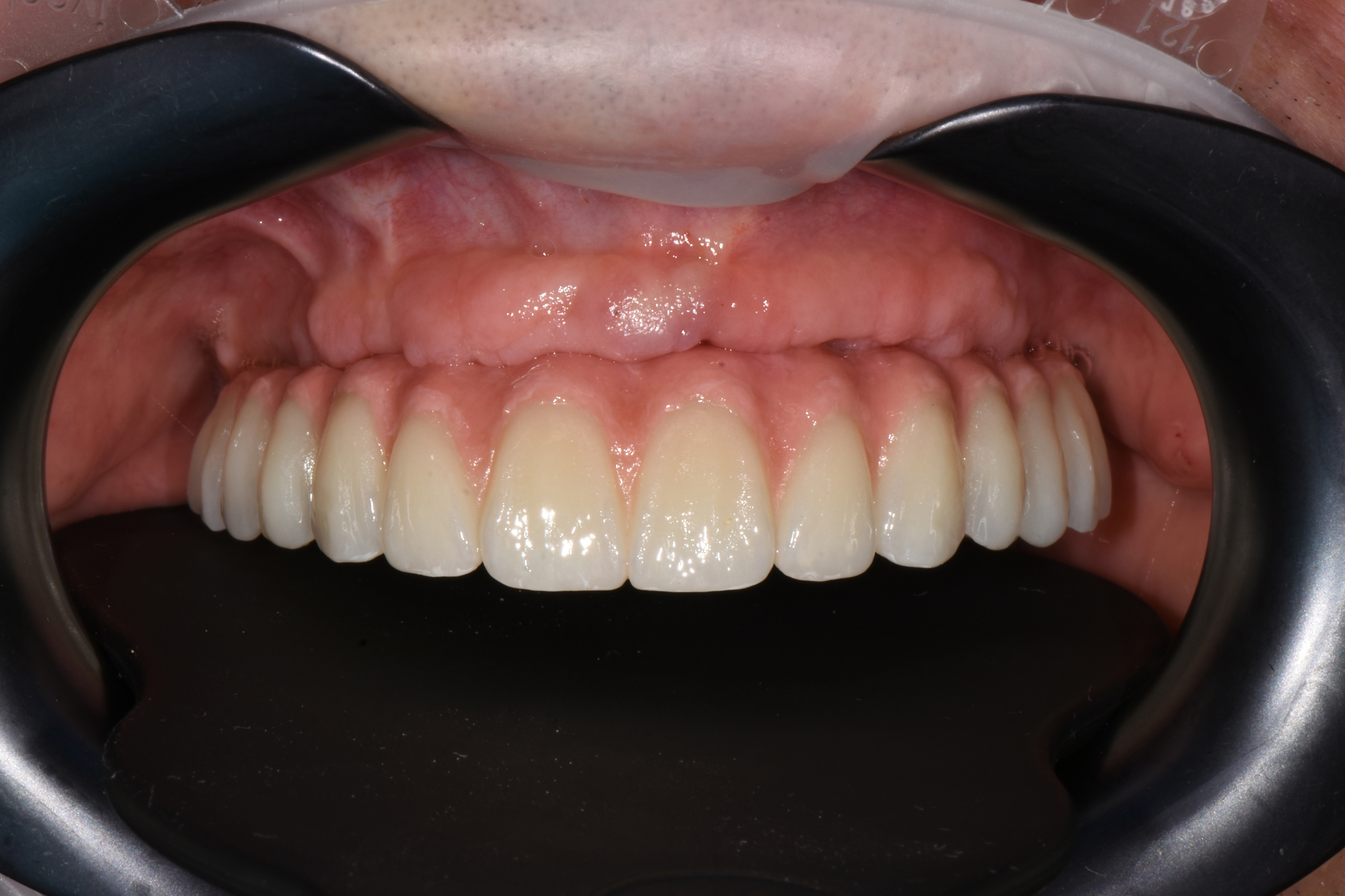 FP3 (o ponte circolare su impianti)